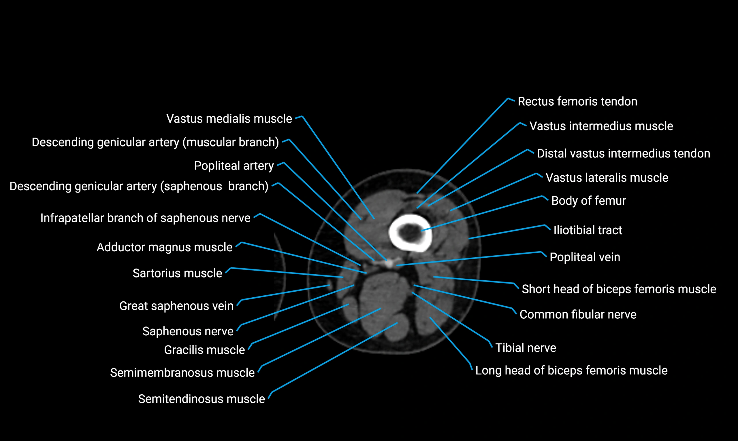 CT lower limb axial cross sectional anatomy labelled image 67 (2).webp